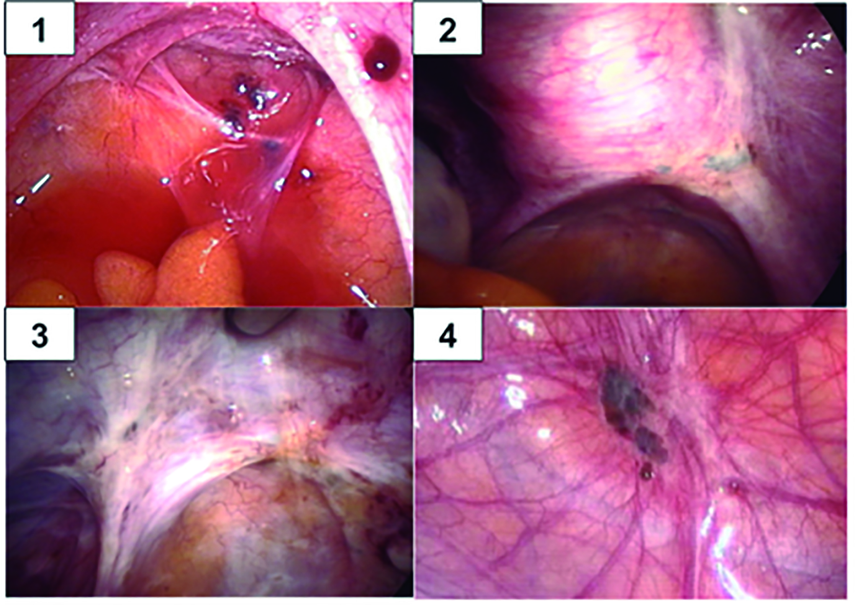 Retirada do Ovário > Cirurgia e Recuperação da Ooforoplastia