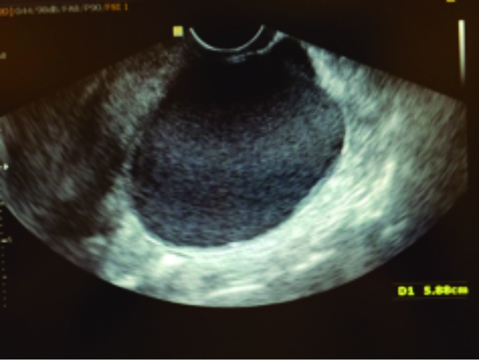 Endometriose  CheckUp da Fertilidade