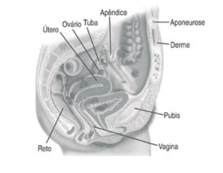 Ooforoplastia laparoscópica e exérese de lesão de endometriose profunda 